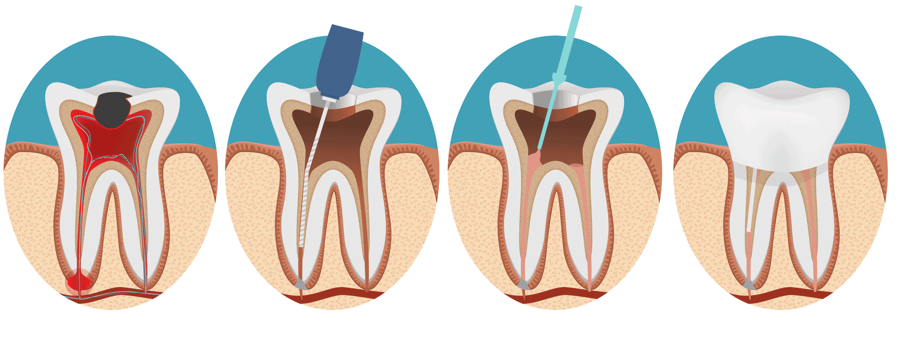 Root Canal Treatment